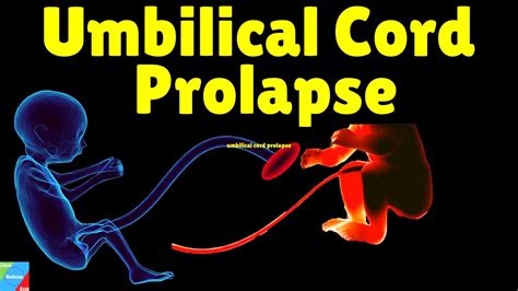 Umbilical Cord Prolapse Cord Prolapse Causes Symptoms Management