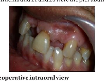 Figure 1 from Treatment of Pier Abutment using NonRigid Connectors ...