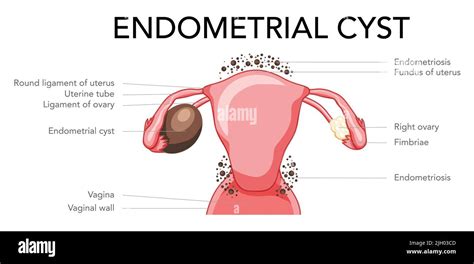 Set Of Ovarian Endometriomas Chocolate Cysts Female Reproductive System