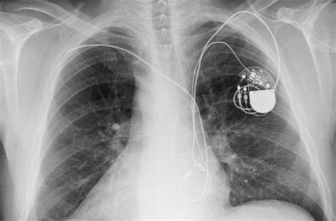 Medtronic Pacemaker X Ray