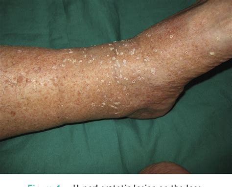 Figure From Dermoscopy Of Erythromelanosis Follicularis Faciei Et