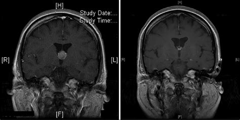 Surgical Neurology International