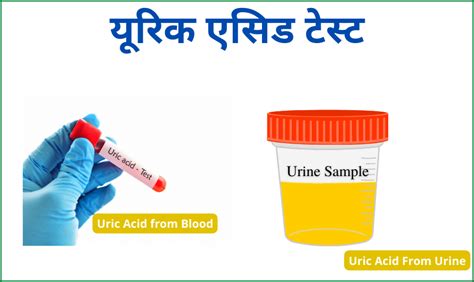 यूरिक एसिड टेस्ट Uric Acid Test In Hindi Normal Range Test Price