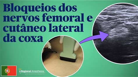 Bloqueios Dos Nervos Femoral E Cut Neo Lateralda Coxa Youtube