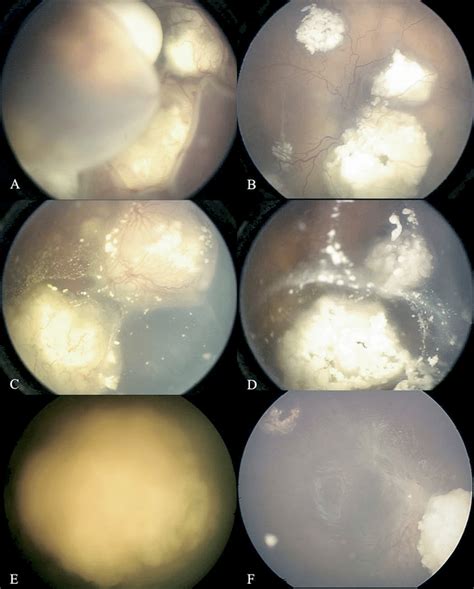 Fundus Photographs Of Eyes With Group E Retinoblastoma Managed With Download Scientific Diagram