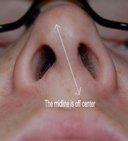 Deviated Nasal Septum - Symptoms, Pictures, Treatment, Surgery