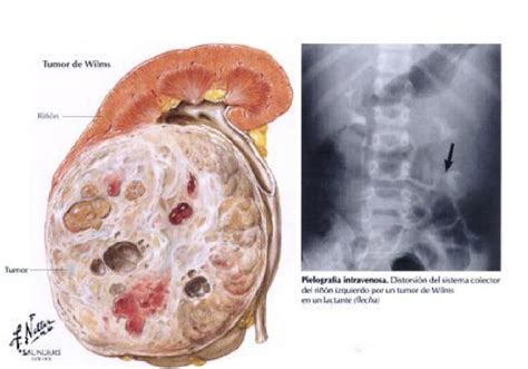 Tumores Renales