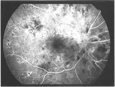 Elschnig Spots Hypertensive Choroidopathy