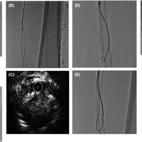 Angiographic Images And An Intravascular Ultrasound Ivus Image Download Scientific Diagram