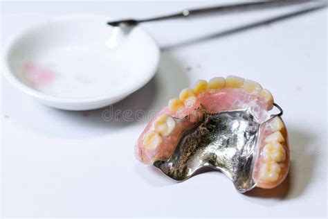 Repair Broken Partial Denture Stock Photo - Image of dental, calculus: 40093604