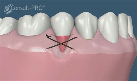 Cirugía mucogingival Injertos de encía Clínica odontológica Dr