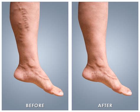 Varicose Spider Vein Treatment Pinellas Vascular