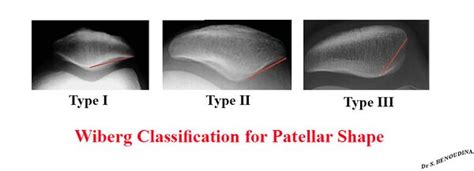 Patella — Wikimedica