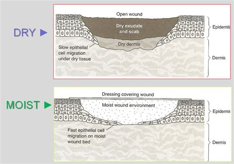 The Benefits Of Moist Wound Healing