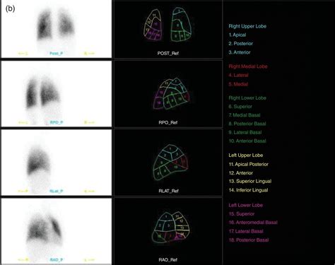 Diseases Of The Pulmonary System Radiology Key