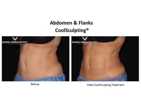 CoolSculpting & CoolTone Before and After Photos