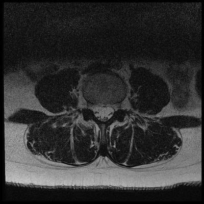 Deep Resolve MRI Ai Mri Reconstruction