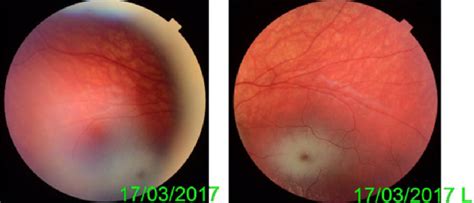 Retinography revealed an image of "cherry-red spot" in the macula in ...