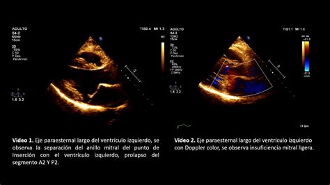 Disyunci N Del Anillo Mitral Prolapso De La V Lvula Mitral Revisi N