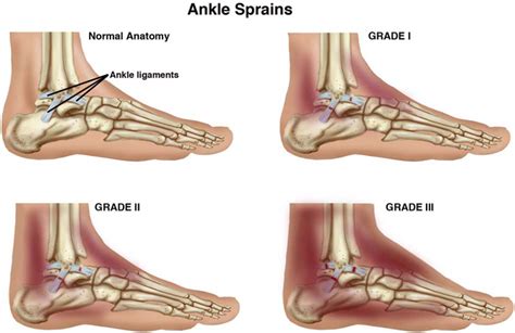 Lateral ankle sprain - Sports & Spinal Albury