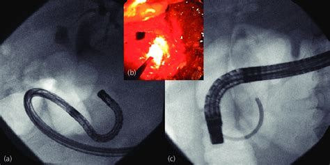 22 Direct Cholangioscopy For Intraductal Lithotripsy Of Stone In