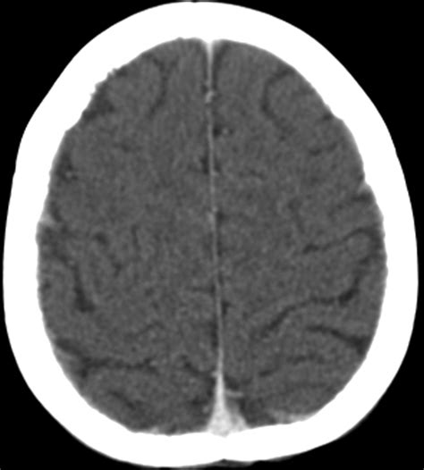 Imaging Of Metastatic Cns Neuroblastoma Ajr