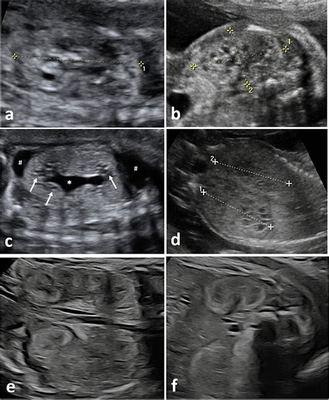 Prenatal Ultrasound In Fetuses With Joubert Syndrome JS