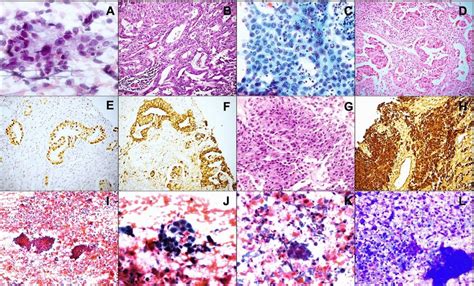 Metastases To Parotid Aspirate Showing Small Round Cells In A Download Scientific Diagram