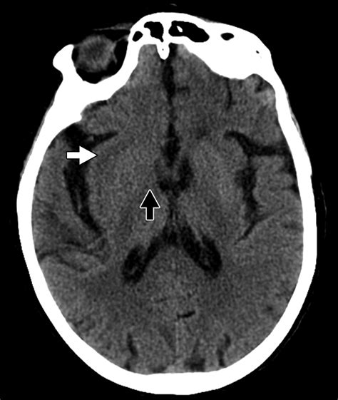 Cerebral Edema Ajr