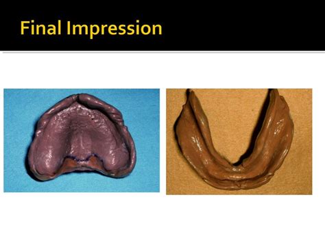 Complete Denture Prosthodontics Step By Step