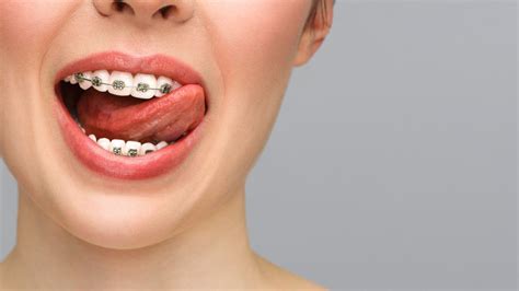 Precio De Los Brackets Invisibles Dental Huelin