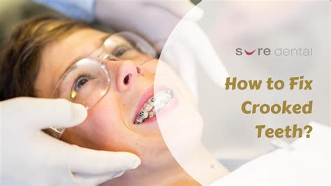 How To Fix Crooked Teeth YouTube