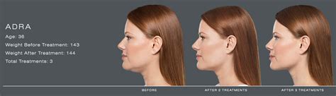 Kybella Double Chin Treatment Carlsbad Encinitas San Diego