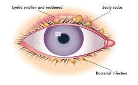 EYE Lid Disorders Conjunctiva Flashcards Quizlet