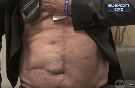 Bolsonaro Mostra Cicatrizes Na Barriga Poder