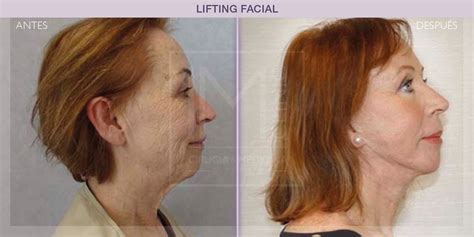 Resultados Lifting Facial Im Clinic