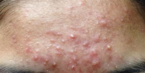 Folliculitis On Face Treatment Doctor Heck