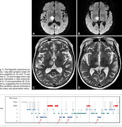 Figure From A Case Of Transient Hypersomnia With Increased Slow Wave