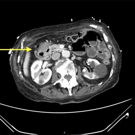 Ct Scan Showing Gastroduodenal Intussusception Yellow Arrow