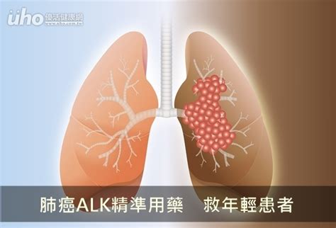 肺癌alk精準用藥 救年輕患者uho優活健康網