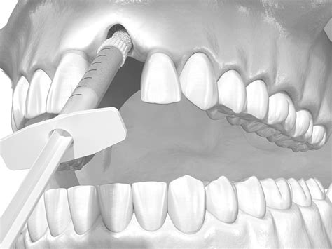 Socket Grafting Post Op Oral Surgeon In Marietta Ga