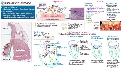 Cardiovascular System Endocarditis Overview Draw It To Know It