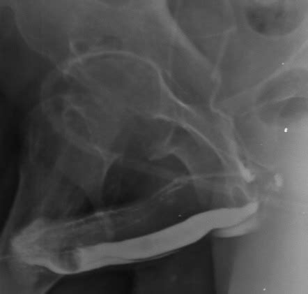 Venous Intravasation Radiology Reference Article Radiopaedia Org