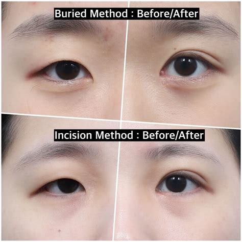 Comparing Surgical Method In Double Eyelid Surgery Korea Noonopi Plastic Surgery Blog