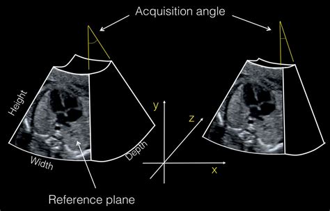 3d Ultrasound Of The Heart