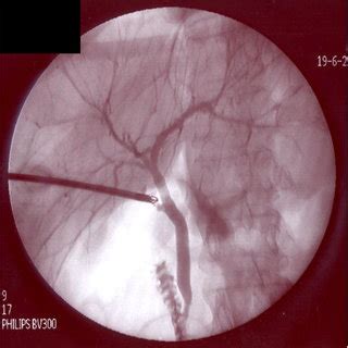 Intraoperative Cholangiography Imaging During Laparoscopic