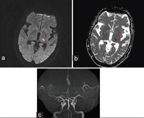 Acute Hemichorea Hemiballism As A Sole Manifestation Of Acute Thalamic