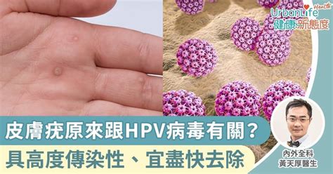 【皮膚疣成因】皮膚疣原來跟hpv病毒有關？具傳染性、宜盡快去除