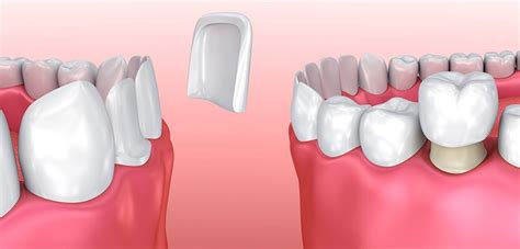 PORCELAIN VENEERS VERSUS DENTAL CROWNS