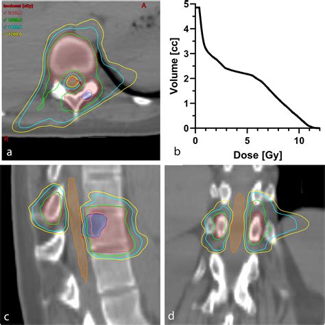 Single And Multifraction Spine Stereotactic Body Radiation Therapy And